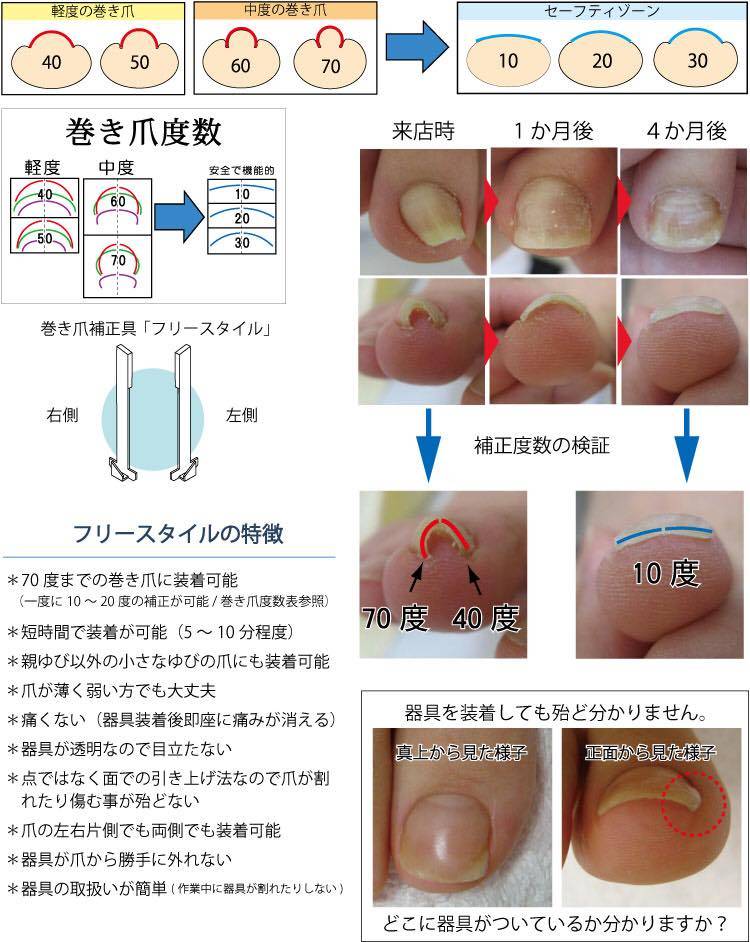 痛くない・美しく仕上がる巻き爪補正