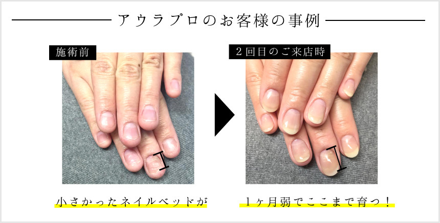 アウラプロのお客様の事例、小さかったネイルベッドが1ヶ月弱でここまで育つ!
