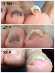 巻き爪が改善した事例