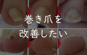 写真:巻き爪を改善したい